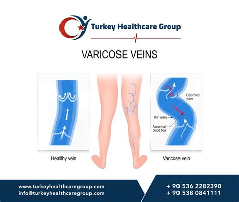 Varicose Veins Surgery Centre Turkey Health Care Group
