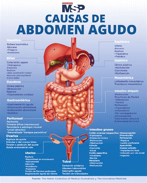Causas de abdomen agudo Infografía