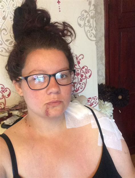 Woman Suffers Horrific Injuries Due To Falling During A Seizure