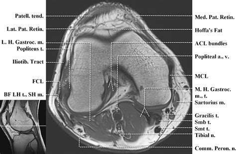 Normal Mr Imaging Anatomy Of The Knee Magnetic Resonance Imaging Clinics