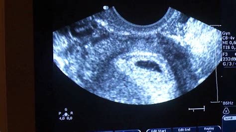 My wife is three months pregnent. Ultrasound with 6,3 week - YouTube