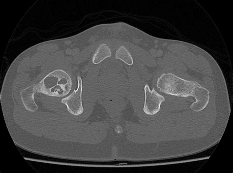 Unicameral Bone Cyst Femoral Neck Image