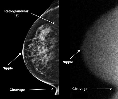 Cc And Mlo Views Of The Breast Download Scientific Diagram