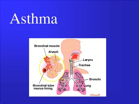 Ppt Asthma Powerpoint Presentation Free Download Id2991929