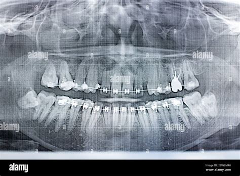 Wisdom Teeth X Ray High Resolution Stock Photography And Images Alamy