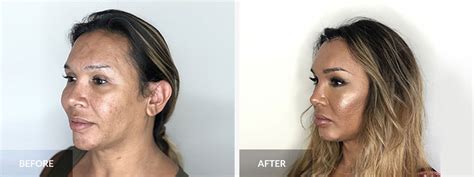 Facial Feminization Surgery Before And After South Florida Center For Cosmetic Surgery