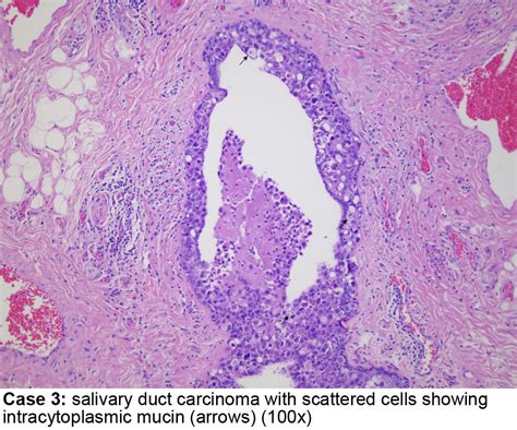 Pathology Outlines Salivary Duct Carcinoma