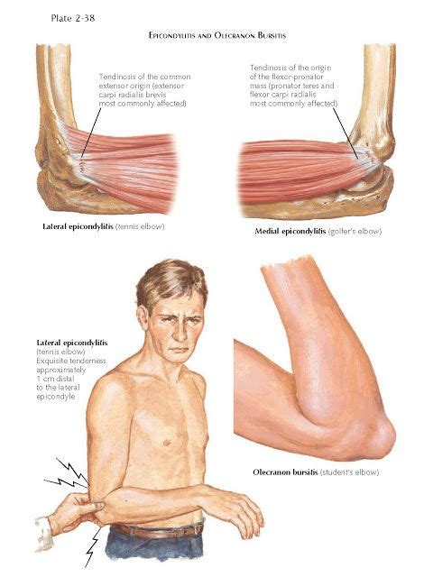 Tendon And Ligament Disorders At The Elbow Artofit
