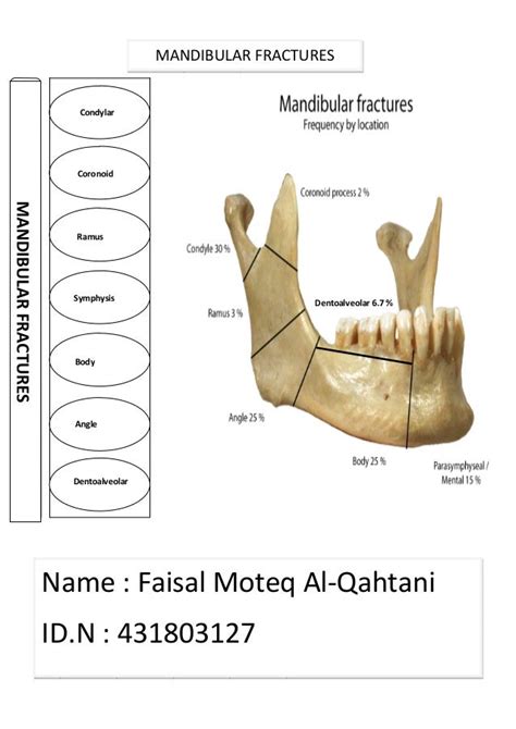 Left Facial Symphysis And Parasymphysis Fracture