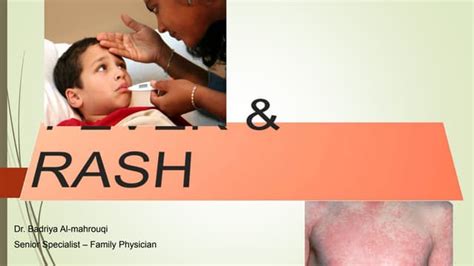 Fever And Rash Ppt