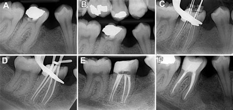 Radiology In Endodontics Pocket Dentistry