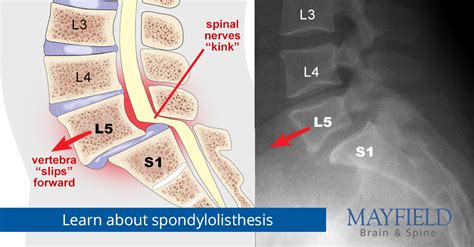 Spondylolysis And Spondylolisthesis Mayfield Brain And Spine