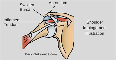 Shoulder Impingement Exercises You Can Do At Home Long Term Fix