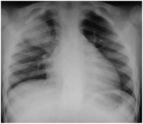 Pneumonia is by far the most common cause of consolidation. Round pneumonia. Chest X-ray obtained in a seven-yearold ...