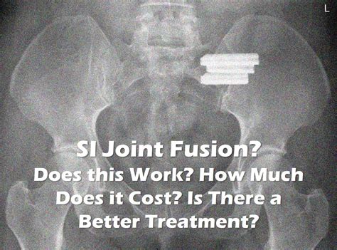 Si Joint Fusion Does This Work Regenexx Blog