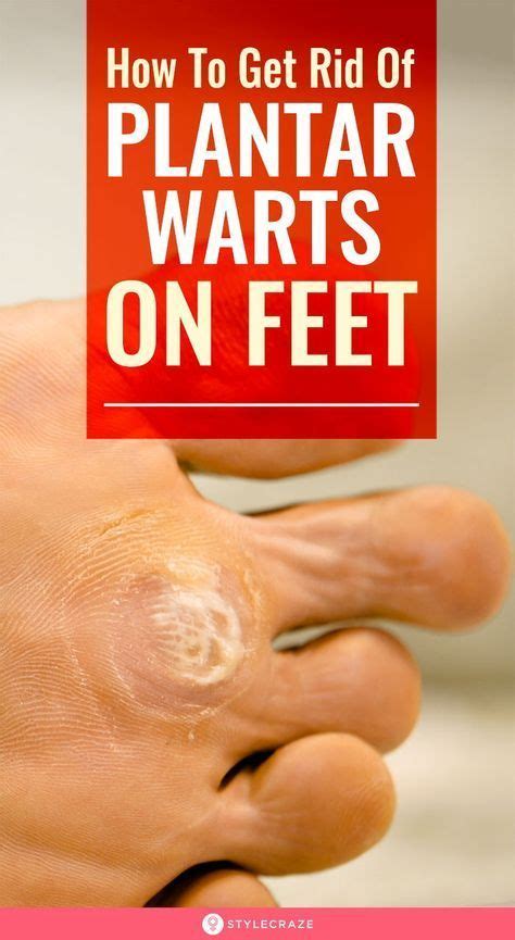 Home Remedies Warts Remedy Plantar Wart Warts On Feet
