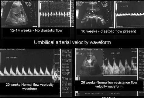 Umbilical Artery Blood Flow