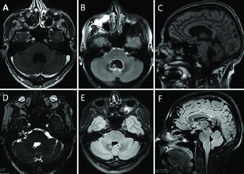 Mri Scans Of Case 2 A C Preoperative Imaging Dilated 4th Ventricle