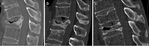 Figure 2 From Spinous Process Fractures In Osteoporotic Vertebral