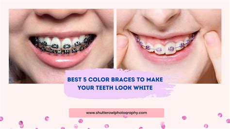 Best 5 Color Braces To Make Your Teeth Look White