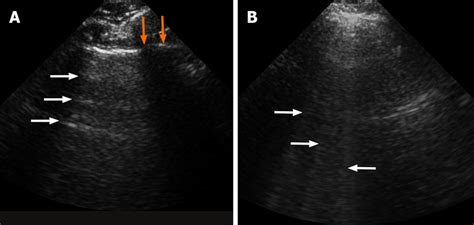 Ultrasonography Imaging Of The Lung Ultrasound Of The Normal Lung Shows