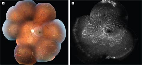 Peripheral Retinal Ischemia Following Posttraumatic Ocular Hypertension