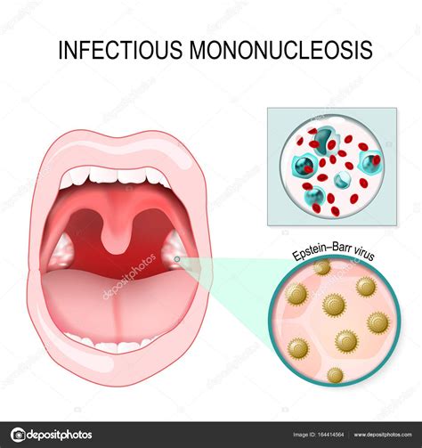 Mononucleosis Infecciosa José Luis Vázquez