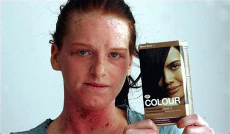 No Incidents Hair Dye Causing An Allergic Reaction