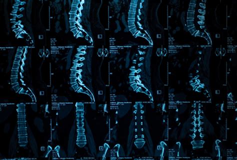 Degenerative Disc Disease Archives Spinal Backrack