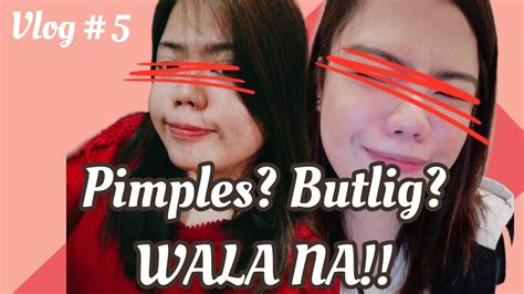Vlog 5 Nawala Na Yung Pimples At Butlig Sa Mukha Ko Skincare