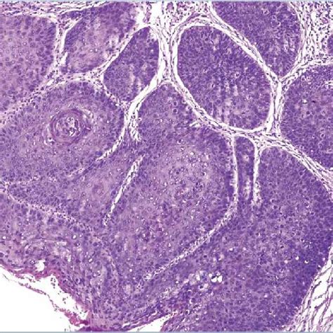 He100x Squamous Cell Carcinoma Moderately Differentiated Download