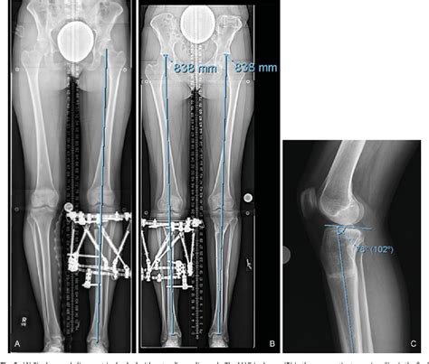 Figure 8 From Does The Surgical Correction Of Tibial Torsion With Genu