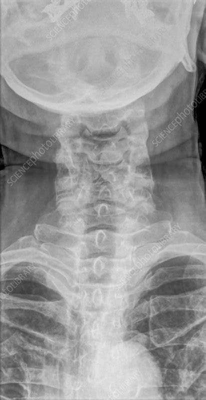 Normal Cervical Spine X Ray Stock Image C0564037 Science Photo