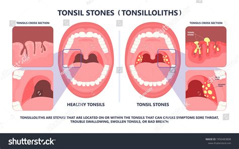Tonsil Stones Crypts Viral Virus Gland Stockvector Rechtenvrij