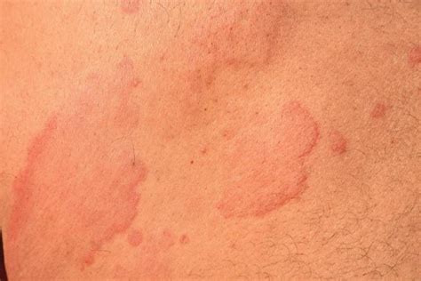Hives Vs Rash What Are The Differences