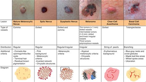 Vascular Skin Lesions Chart