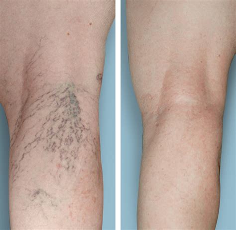 What Is Sclerotherapy Metro Vein Centers