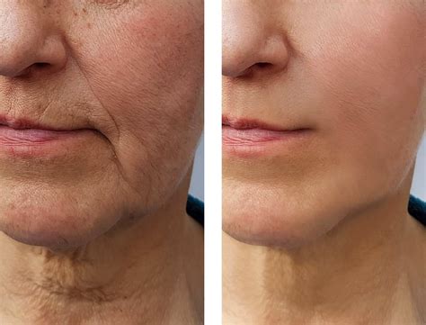 What Is Rf Microneedling Treatment