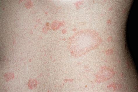 Pityriasis Rosea Photograph By Dr P Marazzi