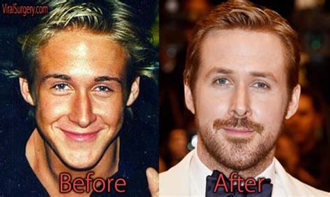 Ryan Gosling Plastic Surgery Before And After Nose Job Pictures