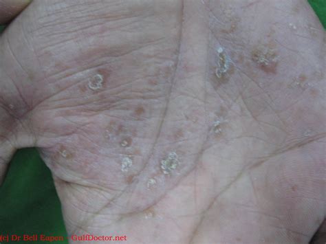 Pityriasis Rosea With Palmar Lesions Dermatologists Sans Borders