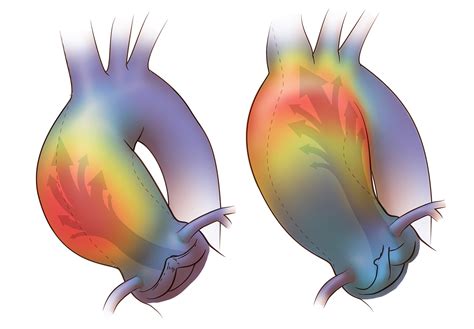Bicuspid Aortic Valve And Aortic Aneurysm On Behance