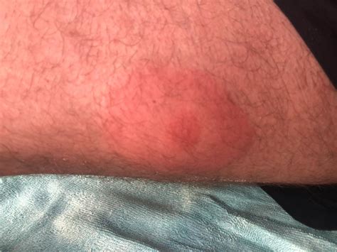 Strong Allergic Reaction From Sandfly Bite Update Borrelia Bacterina