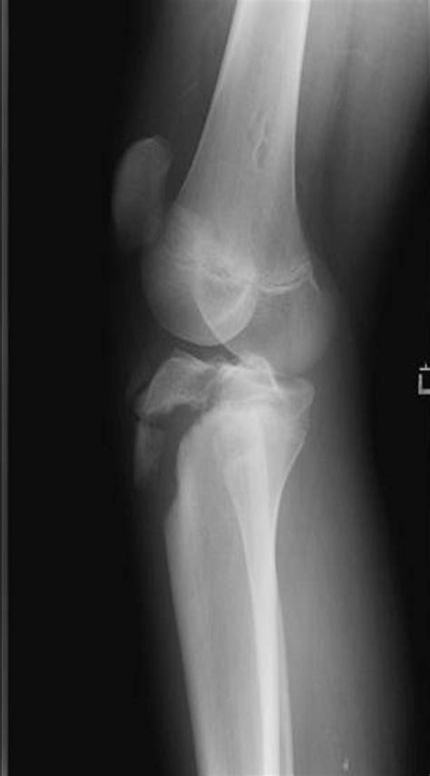 Imaging Review Of Adolescent Tibial Tuberosity Fractures