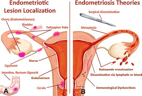 Frontiers Immunological Basis Of The Endometriosis The Complement System As A Potential