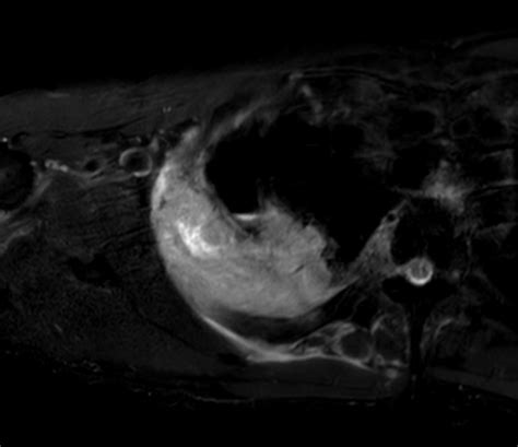 Brachial Plexus Tumor Philips Mr Body Map