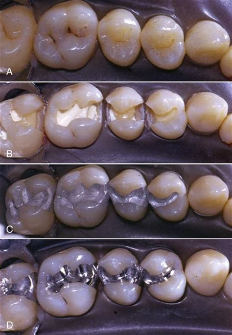 Overview Of Placement Of Amalgam Restorations Teeth That Require