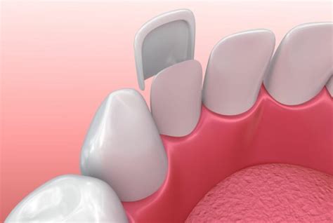Instant Orthodontics With Porcelain Veneers Shemen Dental Group
