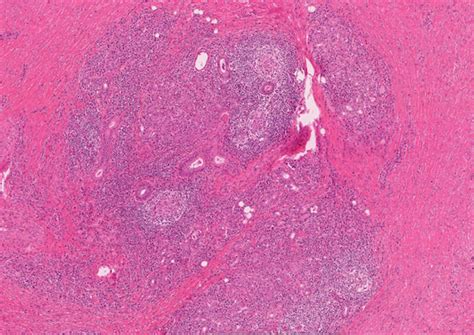 Pathology Outlines Chronic Sialadenitis Sialolithiasis