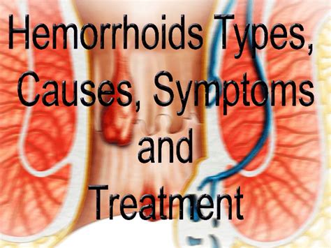 hemorrhoids causes symptoms treatment internal and external hemorrhoid